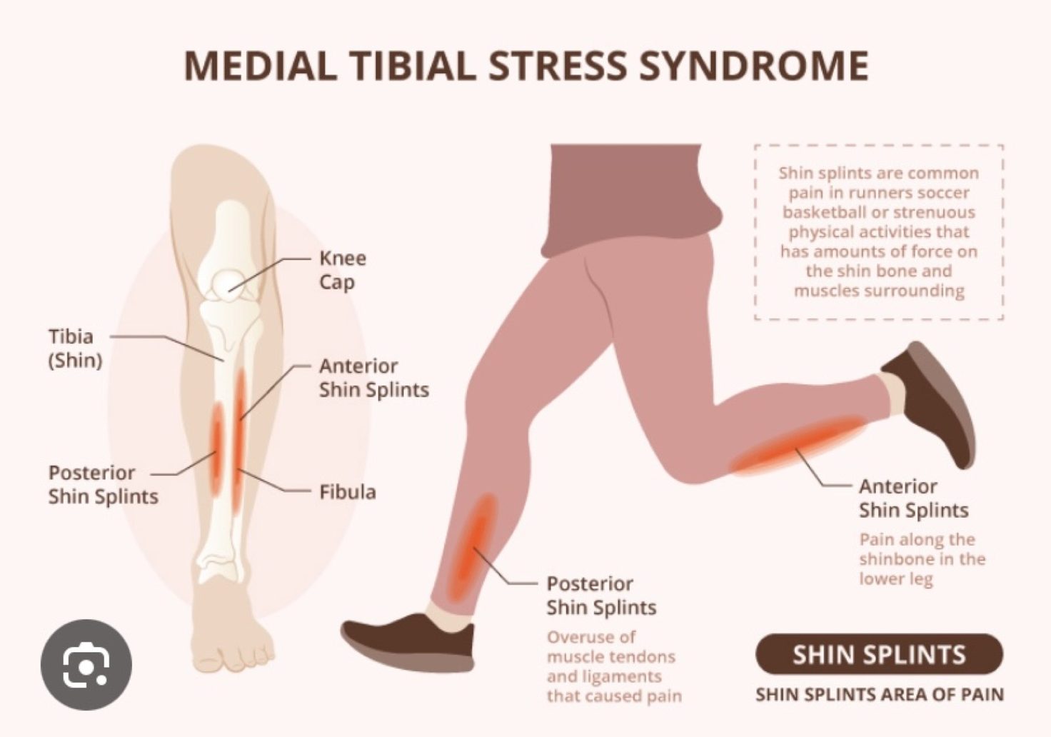 Medial tibial stress syndrome diagram showing anterior and posterior shin splint pain areas on the lower leg